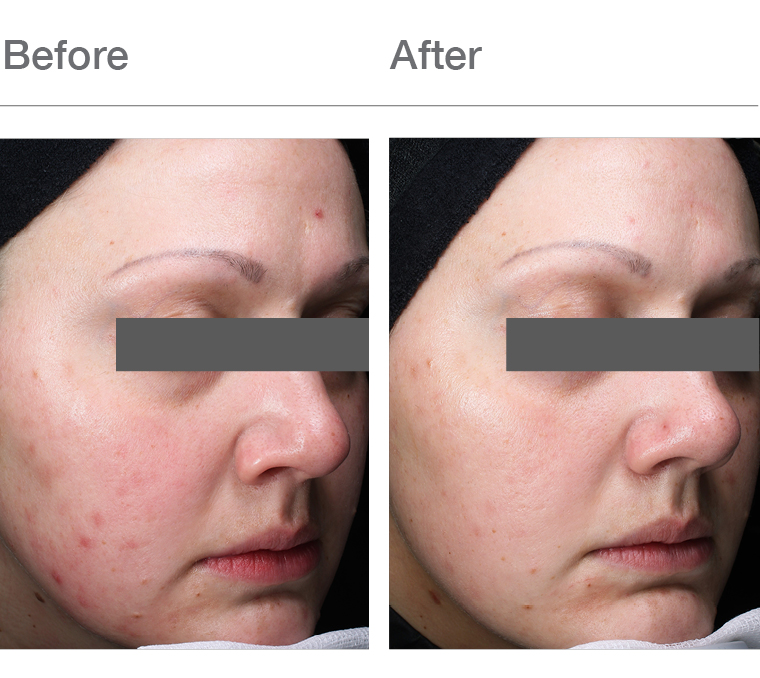 A Healthy Skin Microbiome