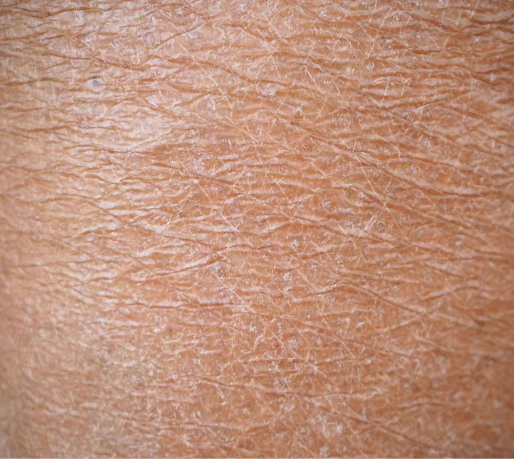 Dry Skin