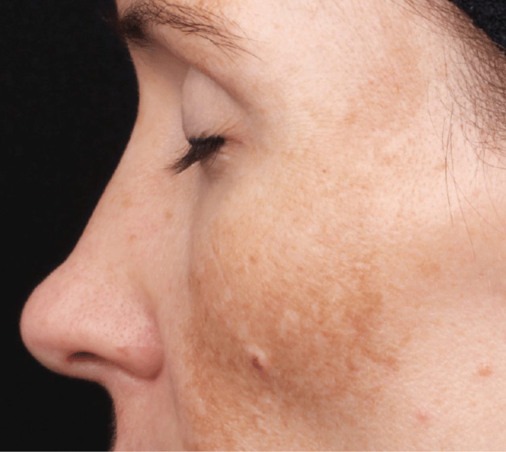 hyperpigmentation before