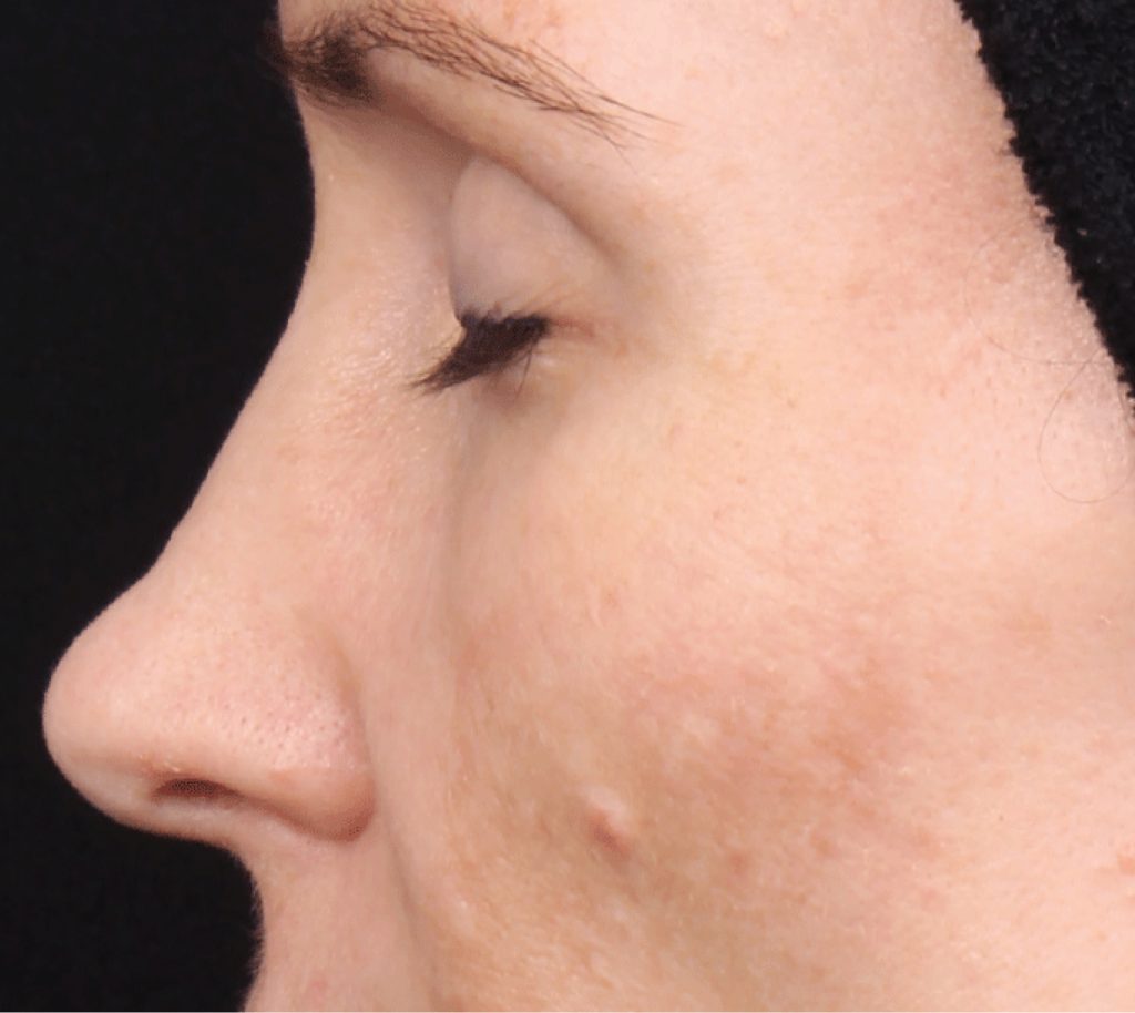 hyperpigmentation After